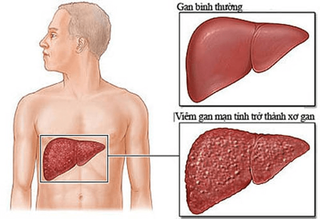 images/Articles/ViemGanB.png